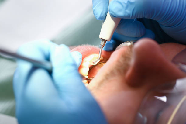 Best Emergency Tooth Extraction in Edwardsville, KS