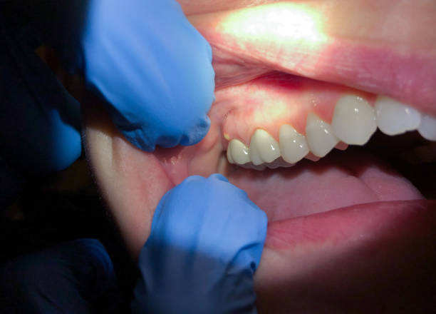 Best Emergency Dental Care for Broken or Chipped Teeth in Edwardsville, KS