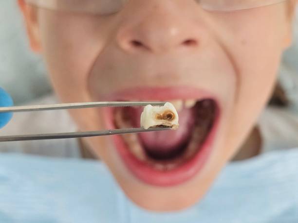 Best Emergency Treatment for Dental Infections or Abscesses in Edwardsville, KS
